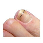 Veertjes (voor nagelbeugels)